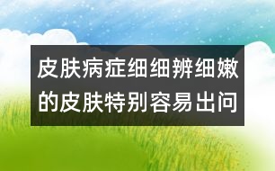 皮膚病癥細細辨：細嫩的皮膚特別容易出問題